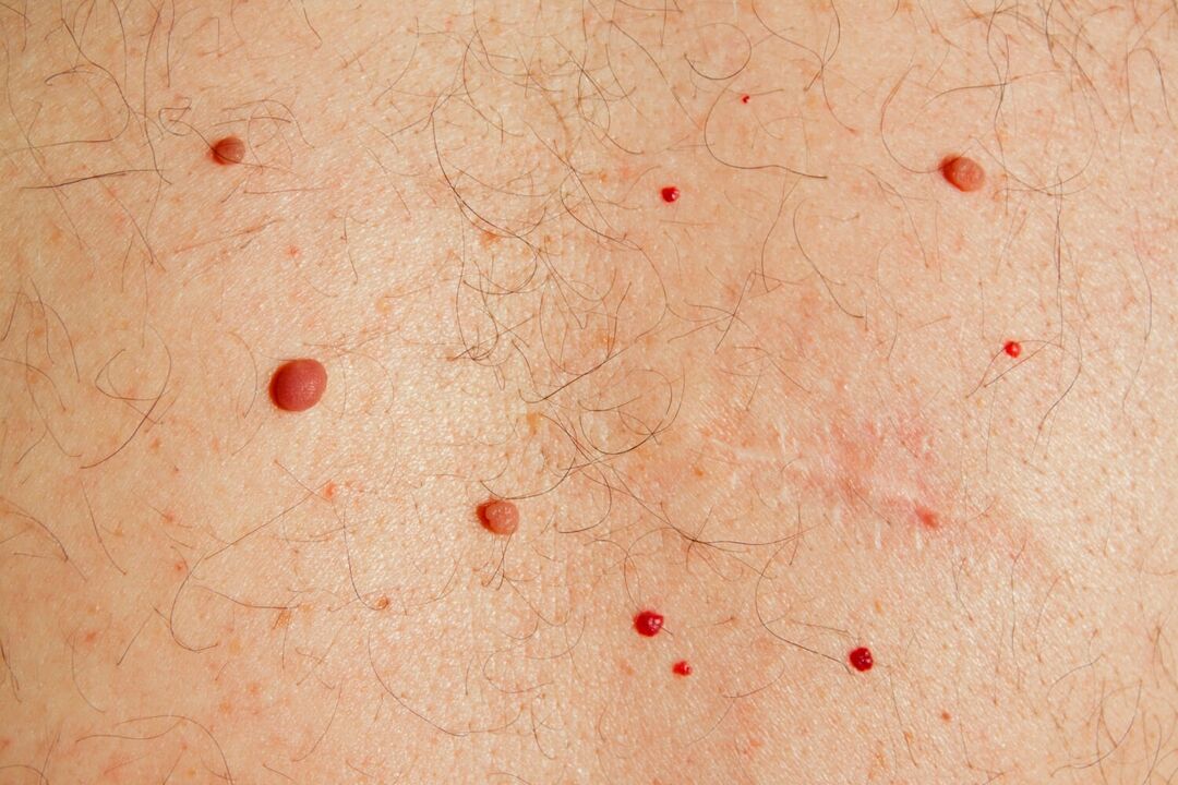 Papilomas uz ķermeņa, ko izraisa HPV