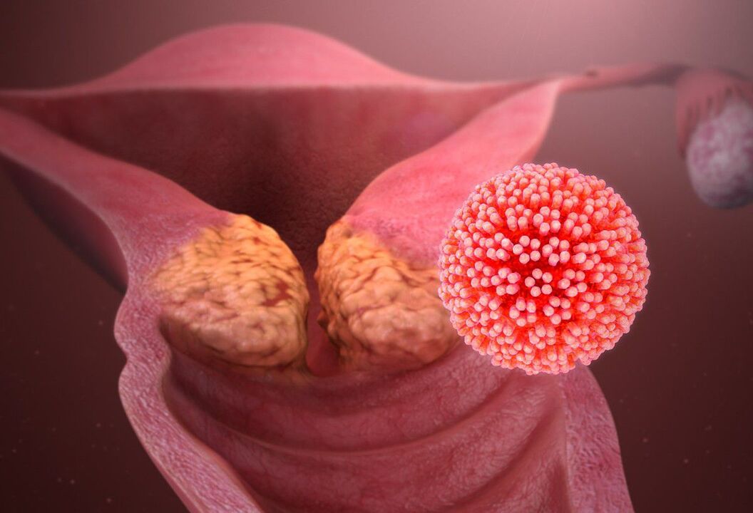 Dzemdes kakla HPV bojājums